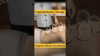 Hijama Therapy || health tips #shorts