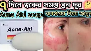 Acne Aid soap review bangla | মুখের ব্রণ দূর করার উপায় ! মাত্র ৭ দিনে😱 Steifel acne aid soap review