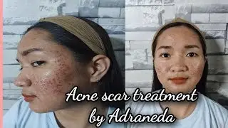 Acne scar treatment Fractional Rf with TCA cross by Adraneda clinic