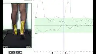 Analyse de la marche, bilan podologique  (avec le logiciel Clinique OPS)