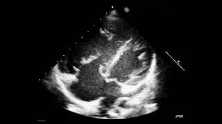 Unroofed Coronary Sinus with Partial AV Canal Defect