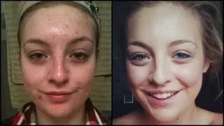 Accutane FAQ Side Effects