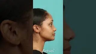 See Results Before Surgery with Digital Imaging #shorts