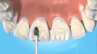 Prima Classic Adhesive Removal Burs