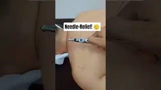 Trigger Point Dry Needling | Real Pain Relief Technique