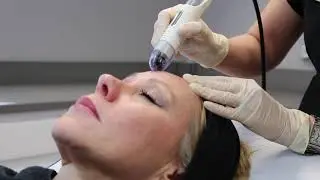 DERMAFRAC Facial