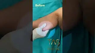 Scarless ArmLift by Dr.TAS