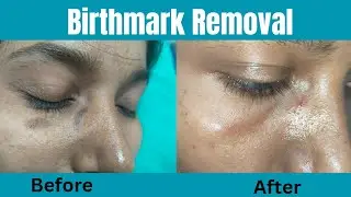 Scarless birthmark removal surgery - 6 month follow up result | Birthmark treatment in Ranchi #scar