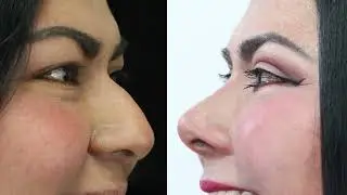 Cirug&iacute;a de P&Aacute;RPADOS + Rinoplast&iacute;a cerrada 👃 Blafaroplast&iacute;a Rino 🔴 Dr Percy Nevado Cirug&iacute;a Pl&aacute;stica