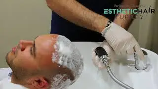 Hair wash after Hair Transplant