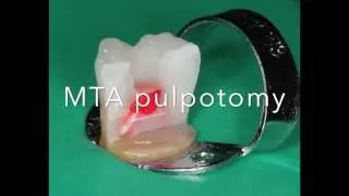 MTA pulpotomy step by step.   by Jorge Casi&aacute;n Adem
