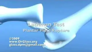 Plantar Plate Function & Rupture w/ Lachman Test 2nd MPJ Pathology Dislocation