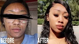 MY SKINCARE ROUTINE | HOW I CLEARED MY ACNE & DARK SPOTS