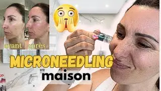 Je TESTE le MICRONEEDLING &agrave; la MAISON avec QURE &ndash; R&eacute;sultat en direct !
