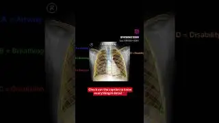 LEARN CHEST XRAY BASICS #education #physio #physiotherapy #chestxray #doctor #shorts