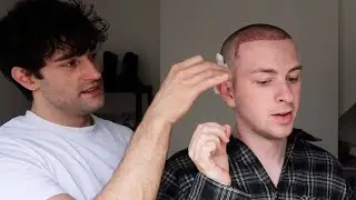 getting a hairline transplant