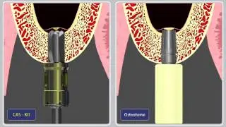 HiOssen Demonstration, CAS-Kit compared to Osteotome