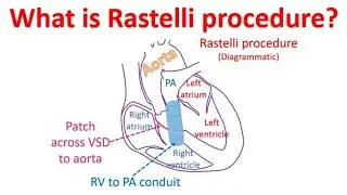 What is Rastelli procedure