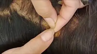 Removed unlimited husband lices challenge ✌️💯 remove lice long hair SH-006