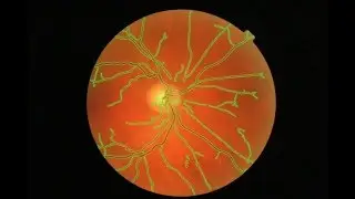 Retina Vessel Finding: MIPAR Helps