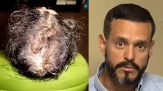 Hair Transplant + PRP | six months after the procedure