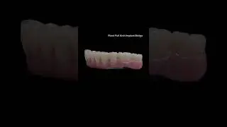 Fixed Full Arch Implant Bridge 🦷