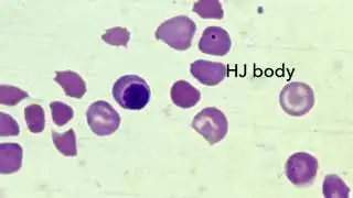 Nucleated RBCs in Blood smear