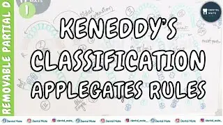 Kennedy&rsquo;s Classification | Applegates rules | Removable Partial Denture | Dr Paridhi Agrawal
