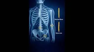 Scientists Reverse Osteoporosis: Triggering the Body to Rebuild Bone