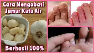 CARA MENGATASI KUTU AIR DI JARI KAKI | CARA MENGOBATI KUTU AIR DENGAN BAWANG PUTIH