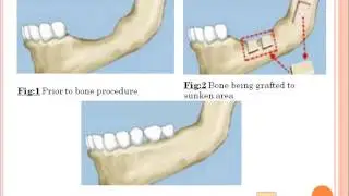 BONE GRAFTS IN DENTISTRY | PRF | BONE REGENERATION | SOCKET PRESERVATION