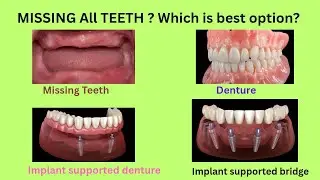 Full Mouth Rehabilitation: Which is Best 1 : Denture  2 : Implant Denture 3 : Implant Fixed Teeth 