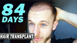 FUE Hair Transplant Day 84 (post op) Istanbul, Turkey GROWTH STAGE