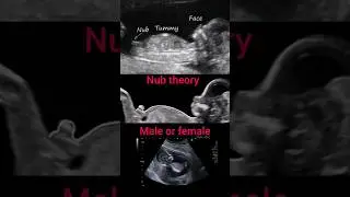 Nub theory||male or female||pregnancy #ultrasound#baby#shorts