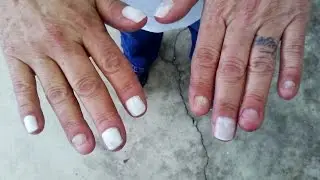 Woman's 50-Year Nail Biting Habit Is Ruining Her Life