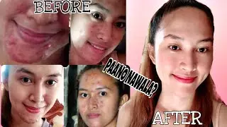 HOW TO GET RID MY PIMPLES & ACNE | ALLERGY | CAUSE BY MASK