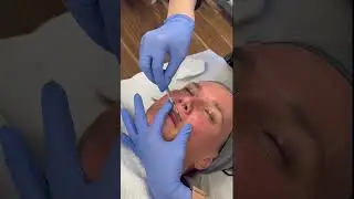 Dermaplaning Treatment! #dermaplaning #skincare #hairremoval #smoothskin