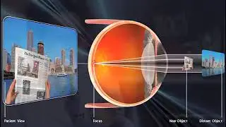 Cataract Lens Options | Kung Eye | Staten Island & East Brunswick