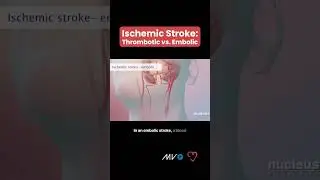 Types of Ischemic Stroke 🧠