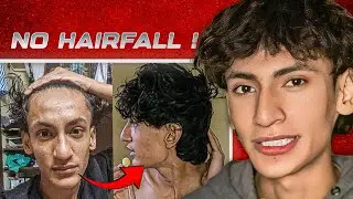 How I Saved Myself From Balding👩‍🦲