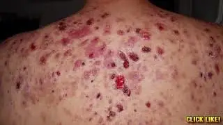 World's Worst Back Acne!  What is Bacne?