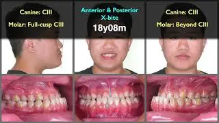 Skeletal Class III with posterior crossbite｜【Chris Chang Ortho】CC807