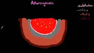 Atherogenesis part 1.mp4