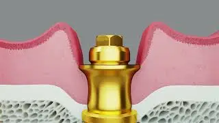 Multi-unit Abutments for conical connection