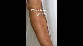 POV: Weak Immune System #health#edit #relatable #iknewyouweretrouble