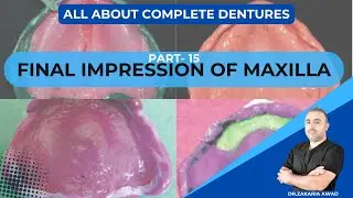 15- الطبعة النهائية للأجهزة الكاملة  العلوية - FINAL IMPRESSION OF UPPER DENTURES