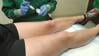 Hyperdilute Radiesse®: Tightening the Skin Above the Knees and Arms