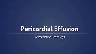 Pericardial effusion water bottle heart sign x-ray