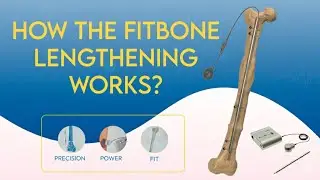 HOW THE FITBONE LENGTHENING WORKS?