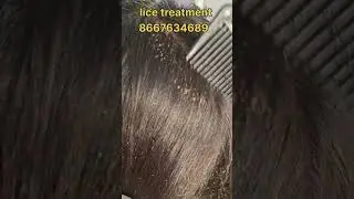How to remove nits and lice treatment #nits #headlice #lice #hairlice removal #peenu #eeru #covai